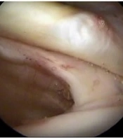 Medium-Term Clinical Outcome of the Arthroscopic Repair of Isolated Subscapularis Tendon Tear