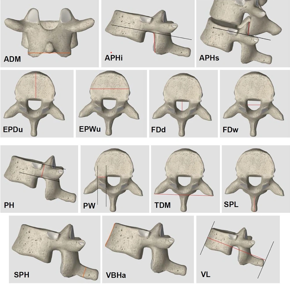 Measured dimensions of the thoracic vertebrae in coronal, sagittal, and axial views: Maximum distance between the articular process (ADm), inferior articular process height (APHi), superior articular process height (APHs), upper endplate depth (EPDu), upper endplate width (EPWu), foramen diameter depth (FDd), foramen diameter width (FDw), pedicle height (PH), pedicle widths (PW), transverse process distance (TDm), spinous process length (SPL), spinous process height (SPH), vertebral body height anterior (VBHa), vertebral length (VL). Measured dimensions of the thoracic vertebrae in coronal, sagittal, and axial views: Maximum distance between the articular process (ADm), inferior articular process height (APHi), superior articular process height (APHs), upper endplate depth (EPDu), upper endplate width (EPWu), foramen diameter depth (FDd), foramen diameter width (FDw), pedicle height (PH), pedicle widths (PW), transverse process distance (TDm), spinous process length (SPL), spinous process height (SPH), vertebral body height anterior (VBHa), vertebral length (VL).