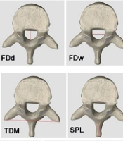 Identification Based on Height, Age, and Gender Estimation Using the Measured Parameters of the T10 and T11 Vertebrae in Three-Dimensional Computed Tomography Scan Among the Iranian Population
