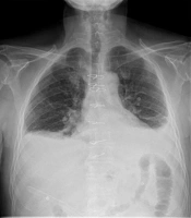 Comparison of Esophagography and Chest Computed Tomography and the Prognostic Value of Inflammatory Markers for Detecting Anastomotic Leakage After Esophageal Resection