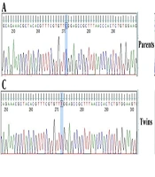 Whole Exome Sequencing Identified a Pathogenic IL2RG Variant in Monozygotic Twins with Severe Combined Immunodeficiency