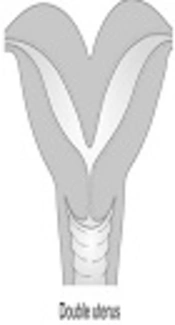 Double Uterus with Single Cervix: A Case Report