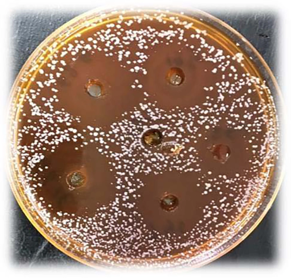 Anti-Microbial Effect of Aloe vera Extract on Clotrimazole-Resistant  Malassezia Furfur Strains Isolated From Patients with Seborrheic Dermatitis  in the City of Sari