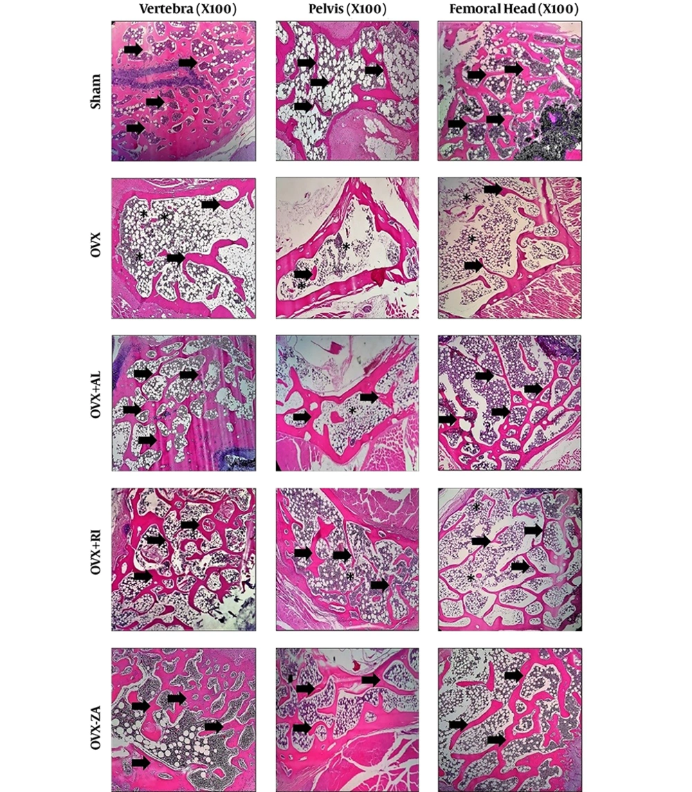 Histopathology section of vertebra, femur, and hip from different experimental groups after 8 weeks post-treatment. Asteroids: loss of interconnectivity, Arrows: trabeculae. OVX: PBS treated ovariectomized rat, OVX-RI: risedronate treated ovariectomized rat, OVX-AL: alendronate treated ovariectomized rat, OVX-ZA: zoledronic acid treated ovariectomized rat. Histopathology section of vertebra, femur, and hip from different experimental groups after 8 weeks post-treatment. Asteroids: loss of interconnectivity, Arrows: trabeculae. OVX: PBS treated ovariectomized rat, OVX-RI: risedronate treated ovariectomized rat, OVX-AL: alendronate treated ovariectomized rat, OVX-ZA: zoledronic acid treated ovariectomized rat.
