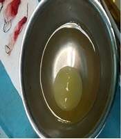 Deep Seated Cerebral Hydatid Cyst and Its Anesthetic Considerations: A Case Report