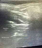 Mastication Muscle Suppression by the Mandibular Branch of Trigeminal Nerve Catheter-Based, Ultrasound-Guided Block: A Case Report