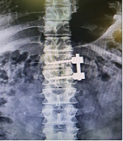 Transpedicular or Transthoracic Approach: An Outcome Comparison Study on Patients with Neurological Manifestation