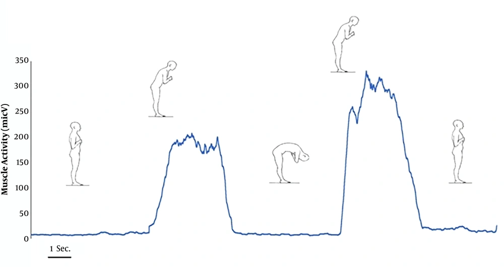 Typical recordings of EMG activity during F-ET. The linear envelope was used to estimate EMG-O and EMG-On points. The extension phase used for the normalization of the EMG linear envelope was also provided. Typical recordings of EMG activity during F-ET. The linear envelope was used to estimate EMG-O and EMG-On points. The extension phase used for the normalization of the EMG linear envelope was also provided.