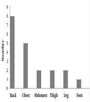 The Rate of Compensatory Sweating and Clinical Outcomes of Selective Thoracoscopic Sympathectomy (Ramicotomy) in Patients with Primary Palmar Hyperhidrosis