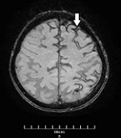 Cover image of the article: Cerebral Amyloid Angiopathy with Cortical Subarachnoid Hemorrhage as a Mimic for Transient Ischemic Attack: A Case Report