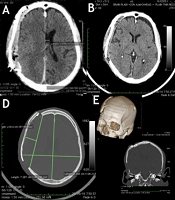 Presenting Step-Ladder Expansive Cranioplasty as the Next Step After Decompressive Hemicraniectomy: It Is Different!