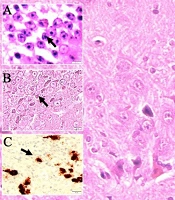 New Histophatological Finding About Data Destroying Amyloid Black Holes in Hippocampus Following Olfactory Bulb Lesion Like as the Universe