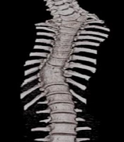 Cover image of the article: Assessment of Rod Bending Accuracy for Sagittal Spinal Deformity Correction on 3D Printed Moulage