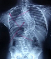 Posteromedial Translation for Correction of Severe Hypokyphosis in Adolescent Idiopathic Scoliosis: Outcome Analysis with 2-year Follow-ups