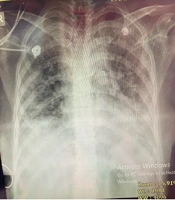 Posterior Reversible Encephalopathy Syndrome in a Hospitalized Pregnant Woman with SARS-CoV-2 Infection: A Case Report