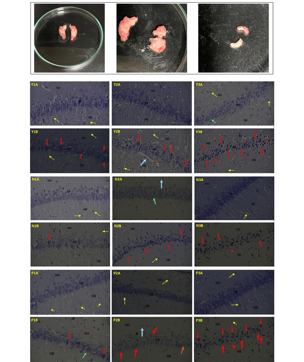 The isolated hippocampus tissue and light micrographs of different layers (SO, SP, SR) of the hippocampus. The most upper row shows the different plates of hippocampus sections (not specified for each condition). Control groups (1A, 2A, 3A) were administered normal saline for 1, 2, and 3 weeks respectively; while the experimental groups (1B, 2B, 3B) were administered methamphetamine for 1, 2, and 3 weeks respectively. Y-maze control (Y1A, Y2A, Y3A) and meth groups (Y1B, Y2B, Y3B). Novel object recognition control (N1A, N2A, N3A) and meth groups (N1B, N2B, N3B). Passive avoidance control (P1A, P2A, P3A) and meth groups (P1B, P2B, P3B). SO, stratum oriens; SP, stratum pyramidal; SR, stratum radiatum, yellow arrows = microglial cells, blue arrow = blood vessels, green arrows=neuronal cytoplasm, red arrows = degenerating/ degenerated cells, red arrowhead = vacuolated cells. Nissl stain, magnification x400. The isolated hippocampus tissue and light micrographs of different layers (SO, SP, SR) of the hippocampus. The most upper row shows the different plates of hippocampus sections (not specified for each condition). Control groups (1A, 2A, 3A) were administered normal saline for 1, 2, and 3 weeks respectively; while the experimental groups (1B, 2B, 3B) were administered methamphetamine for 1, 2, and 3 weeks respectively. Y-maze control (Y1A, Y2A, Y3A) and meth groups (Y1B, Y2B, Y3B). Novel object recognition control (N1A, N2A, N3A) and meth groups (N1B, N2B, N3B). Passive avoidance control (P1A, P2A, P3A) and meth groups (P1B, P2B, P3B). SO, stratum oriens; SP, stratum pyramidal; SR, stratum radiatum, yellow arrows = microglial cells, blue arrow = blood vessels, green arrows=neuronal cytoplasm, red arrows = degenerating/ degenerated cells, red arrowhead = vacuolated cells. Nissl stain, magnification x400.