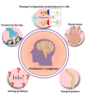 Headache and Dizziness as Prevailing Clinical Manifestations in Parkinson's Patients Following COVID-19