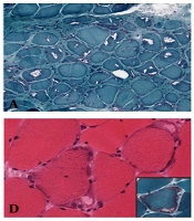 Differential Expression of Immune T-Cell Subpopulations and Pathologic Features in Dermatomyositis, Inclusion Body Myositis and Nonspecific Inflammatory Myopathies