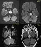 Angioinvasive Cerebral Aspergillosis Presenting with Acute Ischemic Stroke: A Case Report