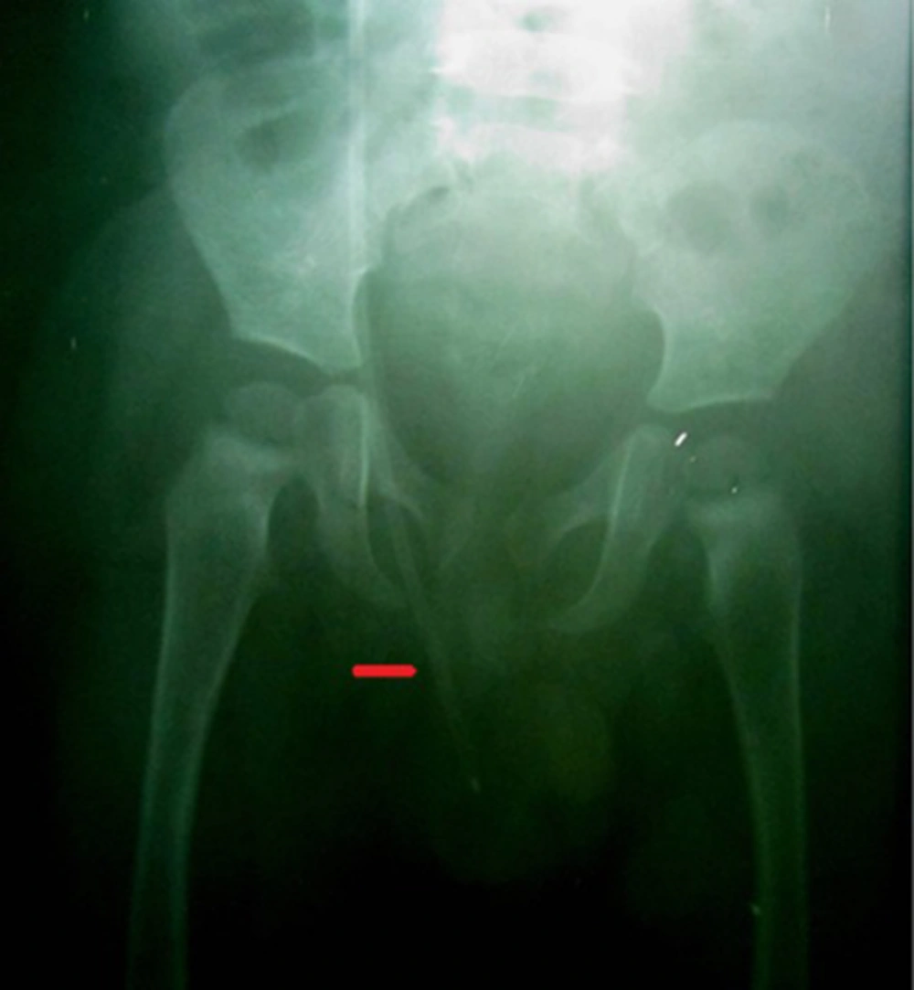 X-ray of peritoneal catheter displacement into scrotum through inguinal canal; red pointer indicates opaque peritoneal catheter. X-ray of peritoneal catheter displacement into scrotum through inguinal canal; red pointer indicates opaque peritoneal catheter.