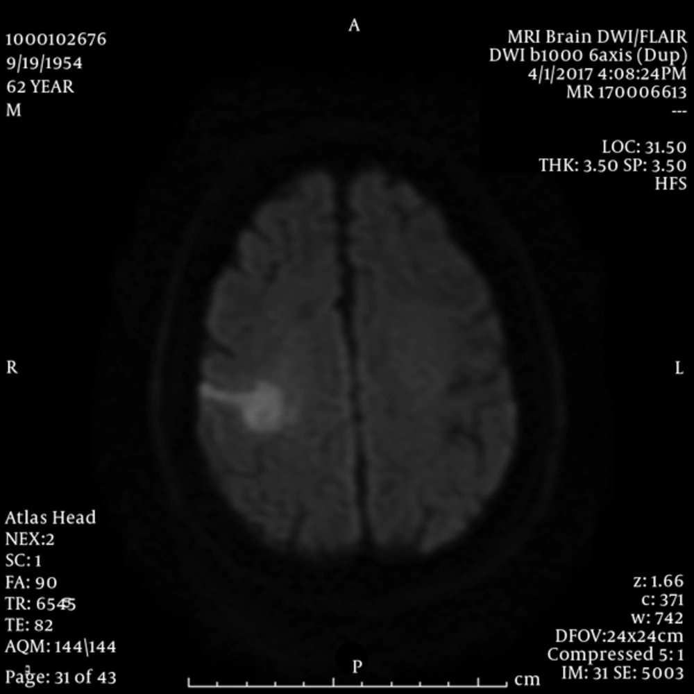 Brain MRI Diffusion Weighted Image Shows Diffusion Restriction in the Right MCA Territory Consistent with Acute to Subacute Infarct Brain MRI Diffusion Weighted Image Shows Diffusion Restriction in the Right MCA Territory Consistent with Acute to Subacute Infarct