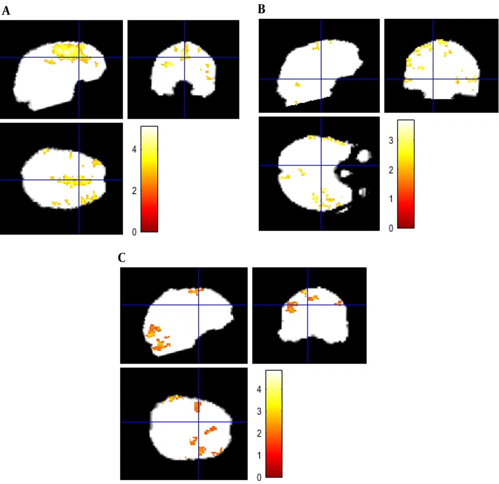 The standard views of the brain (transverse, sagittal, and coronal views) for three patients with brain tumors. For the patients, the areas with higher blood supply are placed at the frontal (A), temporal (B), and occipital (C) lobes, respectively. The standard views of the brain (transverse, sagittal, and coronal views) for three patients with brain tumors. For the patients, the areas with higher blood supply are placed at the frontal (A), temporal (B), and occipital (C) lobes, respectively.