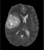 Magnetic Resonance Imaging Segmentation Techniques of Brain Tumors: A Review