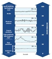Cover image of the article: A Review of Bispectral Index Utility in Neurocritical Care Patients