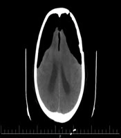 Post Craniotomy Late Fuji Mountain Pneumocephalus: Case Report
