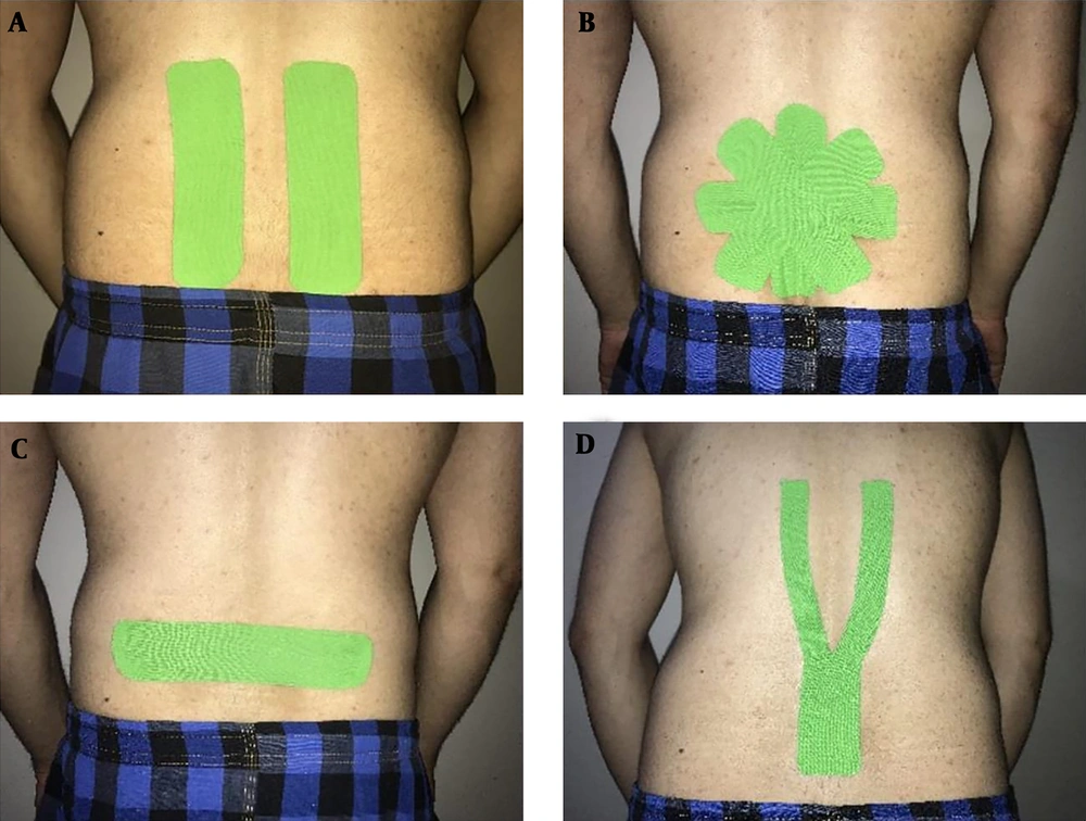 A, I-shaped Kinesio tape (KT) application technique applied bilaterally on the lumbar paravertebral muscles; B, star shape KT application that four I-strips of KT was placed over the point of maximum pain in the lumbar area; C, placebo taping that single I-strip applied transversely immediately above the point of maximum lumbar pain; and D, Y shape KT application that the base of Y strip was applied to the sacroiliac joint region and two tails over the lumbar paravertebral muscles. A, I-shaped Kinesio tape (KT) application technique applied bilaterally on the lumbar paravertebral muscles; B, star shape KT application that four I-strips of KT was placed over the point of maximum pain in the lumbar area; C, placebo taping that single I-strip applied transversely immediately above the point of maximum lumbar pain; and D, Y shape KT application that the base of Y strip was applied to the sacroiliac joint region and two tails over the lumbar paravertebral muscles.