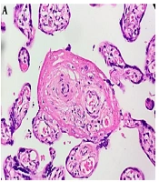 Cover image of the article: Importance of Serological Tests in the Diagnosis of Asymptomatic Congenital Syphilis in Neonates: A Case Report