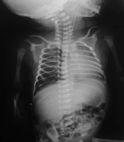 Neonatal SARS-CoV-2 Infection and Congenital Myocarditis: A Case Report and Literature Review