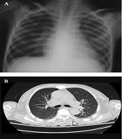 Cover image of the article: Differentiation Syndrome Mimicking COVID-19 Pneumonia