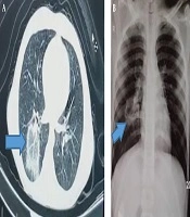 COVID-19 and Chickenpox as a Viral Co-Infection in a 12-Year-Old Patient, a Case Report