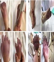 Association of COVID-19 Infection and Purpura Fulminans