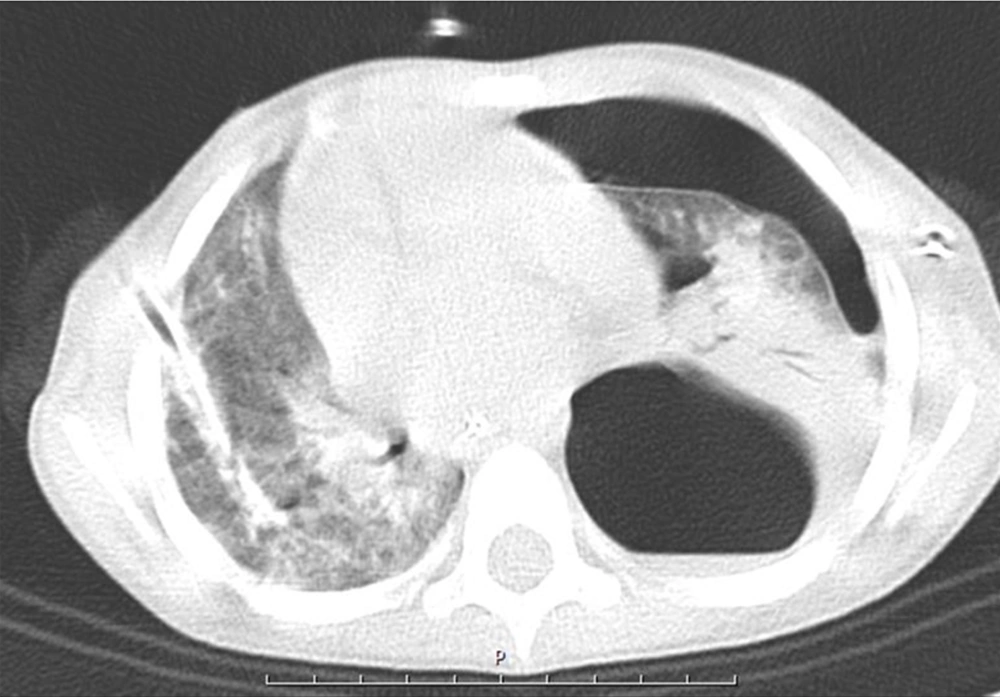 Large Left Side Pneumatocele with Air Fluid Level and Pneumothorax Large Left Side Pneumatocele with Air Fluid Level and Pneumothorax
