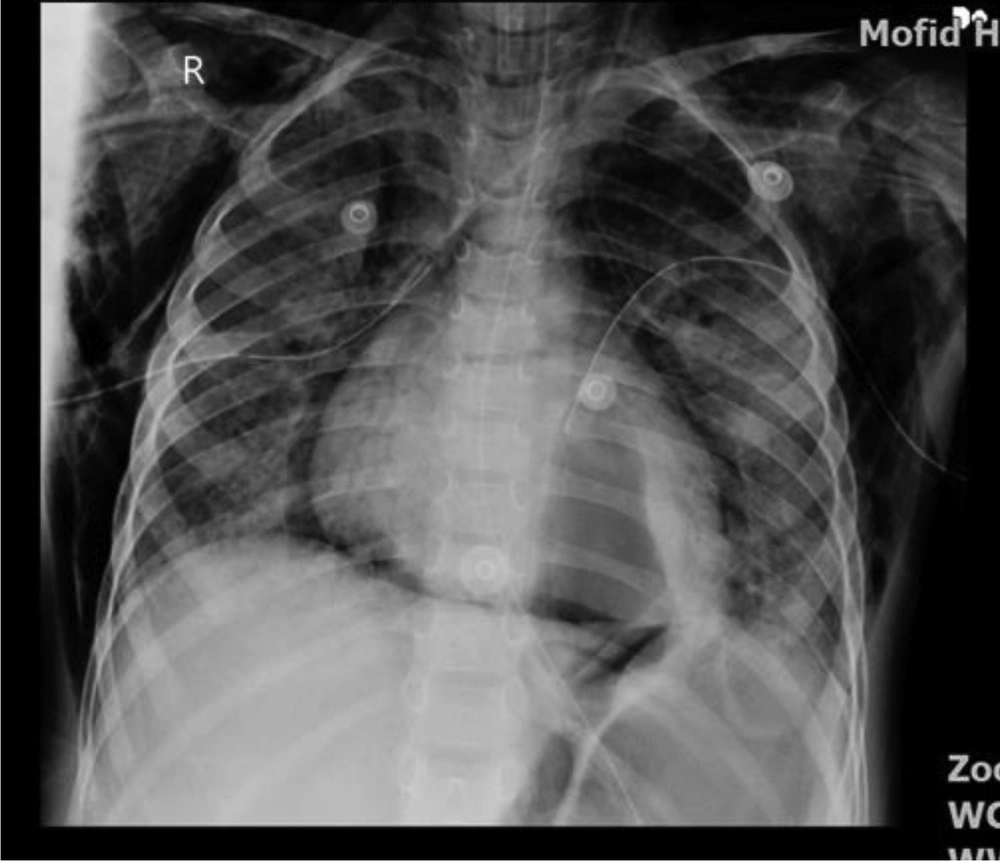 Mediastinal emphysema and left side pneumothorax and pneumatocele Mediastinal emphysema and left side pneumothorax and pneumatocele