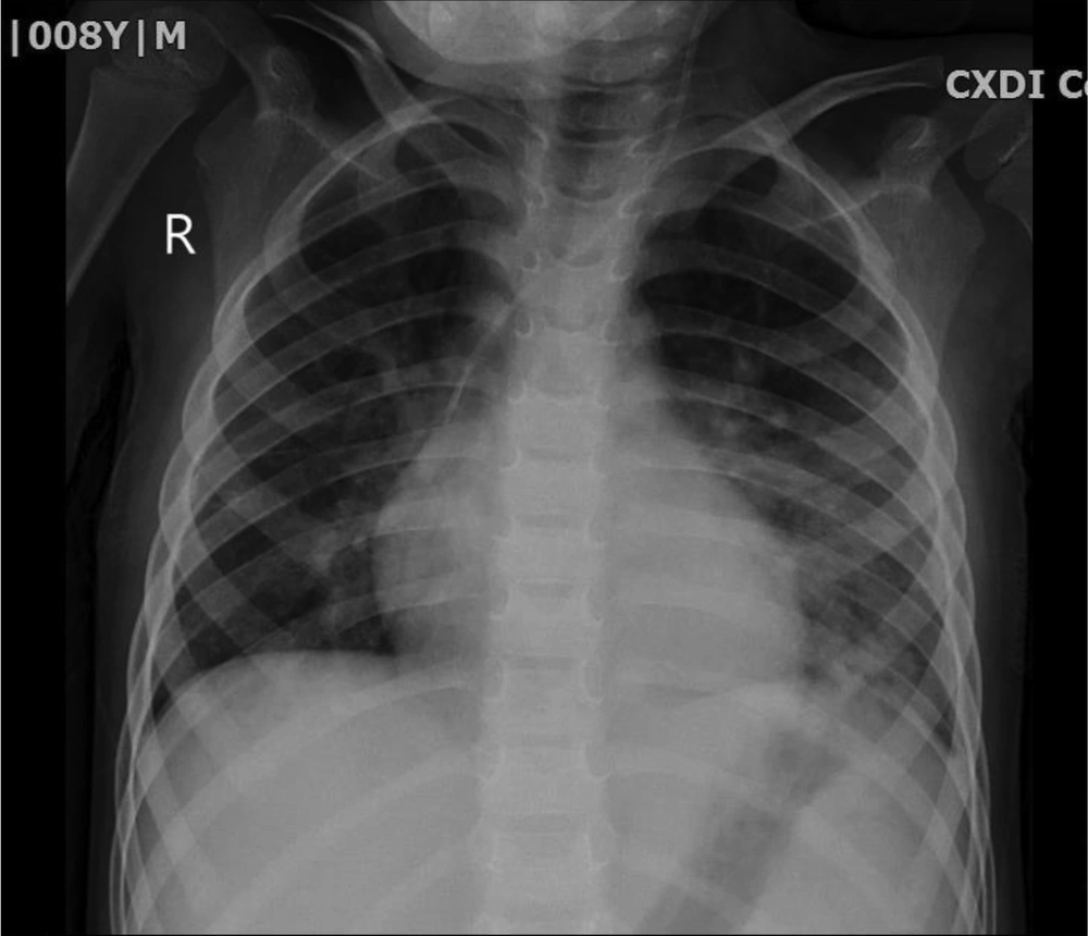 The near normal chest X-ray of patient after the therapy The near normal chest X-ray of patient after the therapy