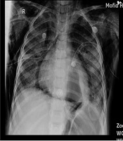 Cover image of the article: A Child with Influenza A and Large Pneumatocele