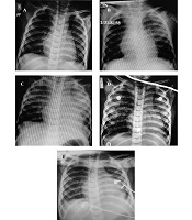 Successful Recovery of a Child with COVID-19-Induced Secondary Hemophagocytic Lymphohistiocytosis