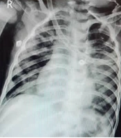 Spontaneous Pneumothorax in a Child with COVID-19