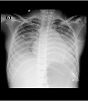 Successful Treatment of Severely Hypotensive Pediatric Patients with Multisystem Inflammatory Syndrome in Children (MIS-C) with the Guidance of Invasive Hemodynamic Monitoring: A Report of Three Cases