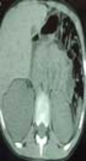 Renal Actinomycosis, A Rare Diagnosis Which Can Clinically Mimic a Malignancy, Case Report and Review of the Literature