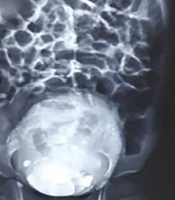 Urinary Tract Infection by Enterobacter sakazakii: A Case Report