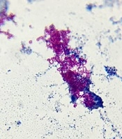 Cover image of the article: Sulfonamide-Resistant Nocardia Isolated from Alveolar Dental Abscesses in a Child with ALL: A Case Report