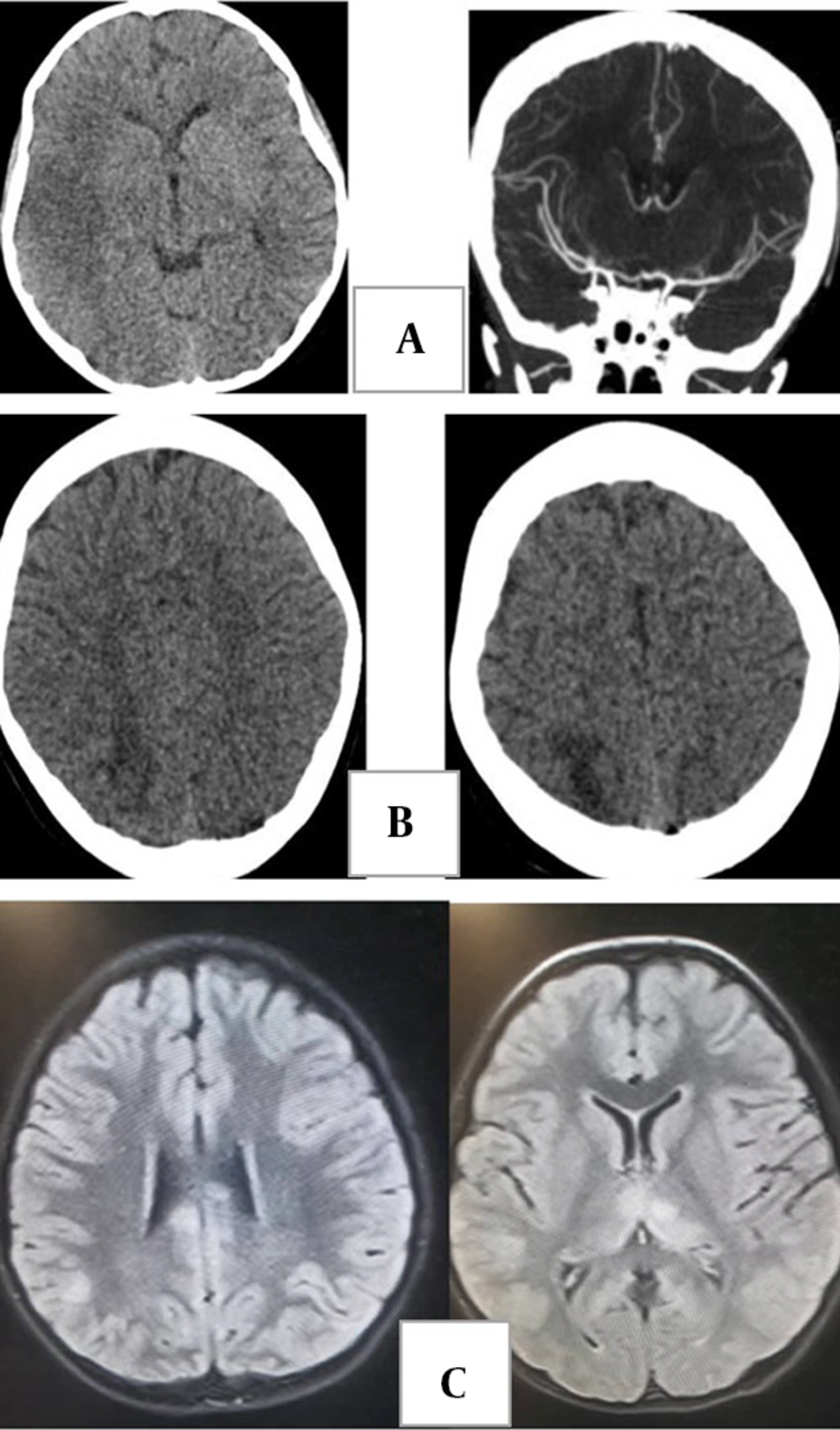 A, brain computed tomography (CT) without contrast and CT angiogram in a 7-year-old boy with a diagnosis of multisystem inflammatory syndrome in children (MIS-C) who presented with left hemiparesis. Images show hypodensity in the territory of the right middle cerebral artery (ischemic infarct). The CT angiogram shows duplicated middle cerebral artery on the right side as a variant. B, brain CT in a 12-year-old boy with a diagnosis of MIS-C who presented with headache and seizure during treatment, demonstrating asymmetric bilateral subcortical hypodensity in parieto-occipital lobes compatible with posterior reversible encephalopathy syndrome. C, acute disseminated encephalomyelitis (ADEM) in an 8-year-old girl with recent history of coronavirus disease 2019 (COVID-19) who presents with loss of consciousness. Fluid-attenuated inversion recovery images show scattered abnormal signal in subcortical white matter and bilateral thalami. A, brain computed tomography (CT) without contrast and CT angiogram in a 7-year-old boy with a diagnosis of multisystem inflammatory syndrome in children (MIS-C) who presented with left hemiparesis. Images show hypodensity in the territory of the right middle cerebral artery (ischemic infarct). The CT angiogram shows duplicated middle cerebral artery on the right side as a variant. B, brain CT in a 12-year-old boy with a diagnosis of MIS-C who presented with headache and seizure during treatment, demonstrating asymmetric bilateral subcortical hypodensity in parieto-occipital lobes compatible with posterior reversible encephalopathy syndrome. C, acute disseminated encephalomyelitis (ADEM) in an 8-year-old girl with recent history of coronavirus disease 2019 (COVID-19) who presents with loss of consciousness. Fluid-attenuated inversion recovery images show scattered abnormal signal in subcortical white matter and bilateral thalami.