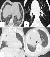 Narrative Review Article: Radiographic Findings in COVID-19 and MIS-C in Children