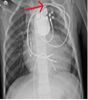 Recurrent Cardiovascular Implantable Electronic Device Infection: A Case Report