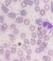 A Rare Case of Acute Liver Failure in an Infant: Unmasking the Hidden Threat of HHV-6 — A Case Report and Review of the Literature
