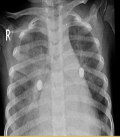 Case Report of an Unusual Presentation of Brain Ischemia and Herniation in a Four Years Old Girl with COVID-19 Infection